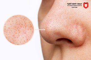 مسام الوجه الواسعة